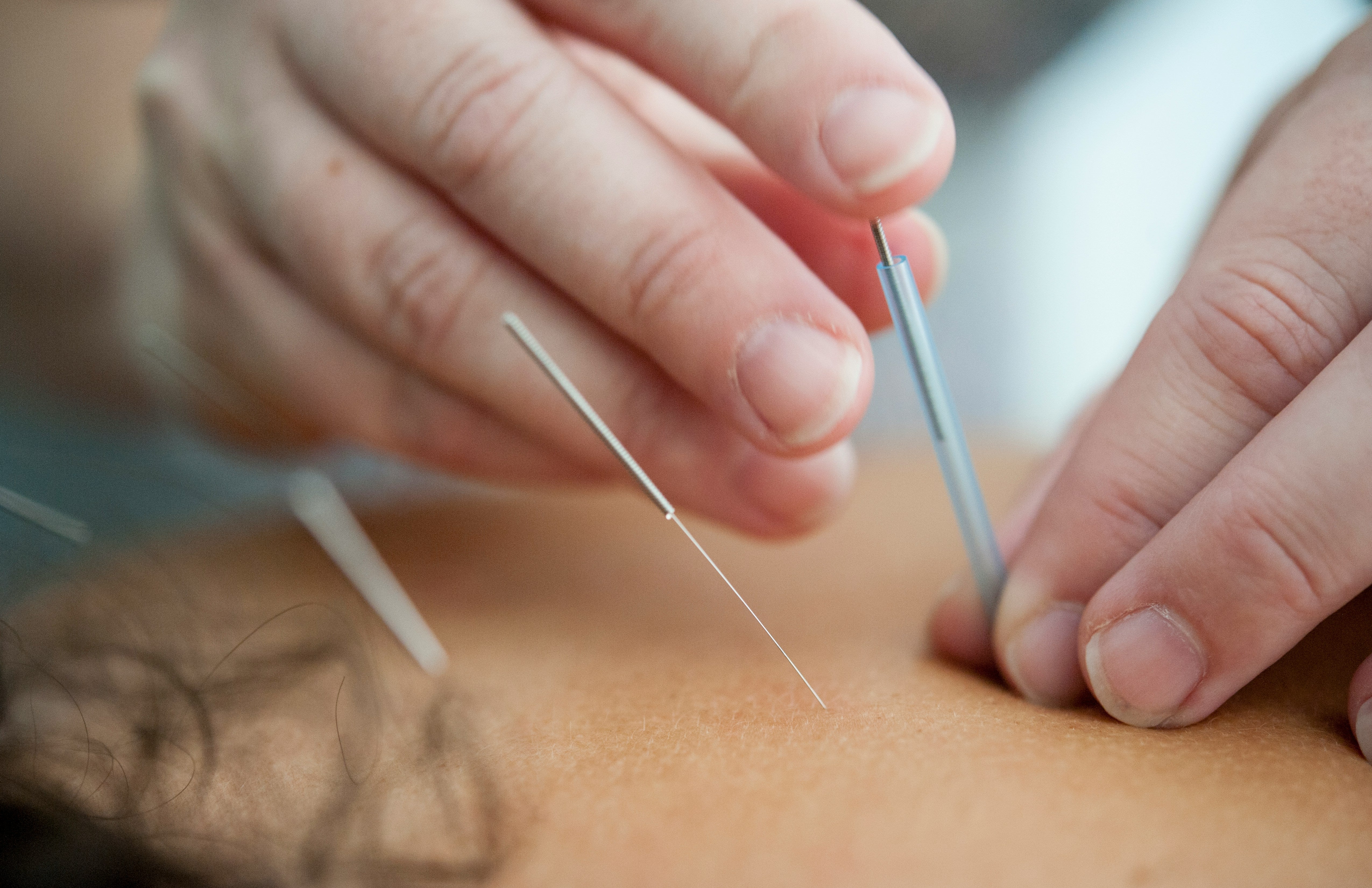 Acupuncture and fertility - can it actually help?